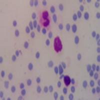 blood cell cancer detection  project thumbnail