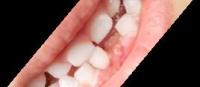 Dental Disease Detection project thumbnail