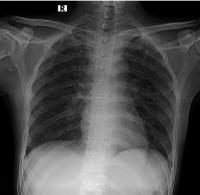 TB CXR project thumbnail
