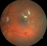 DIABETIC RETINOPATHY project thumbnail