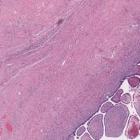 Ovarian Cancer Subtype  project thumbnail