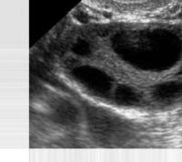 PCOS Detection project thumbnail