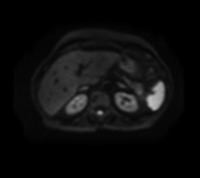 Hepatic-cancer project thumbnail