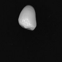 tooth anterior upper project thumbnail