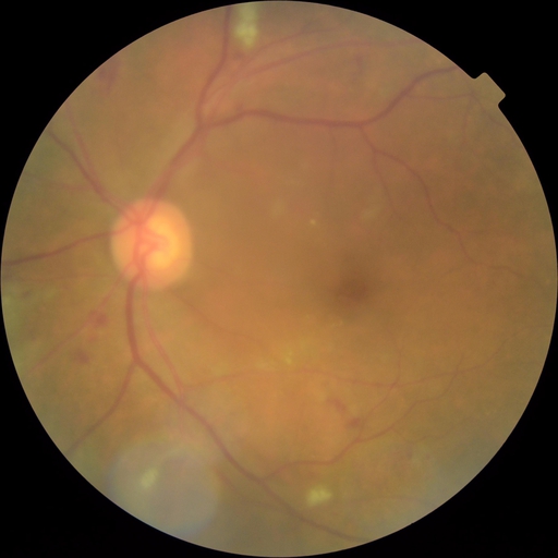 diabetic-retinopathy Classification Dataset by Biomedical engineering ...