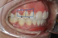 Dental_Lesion project thumbnail