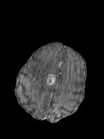 brain-tumor-Final project thumbnail