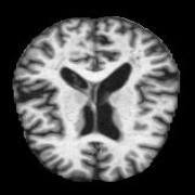 MRI - Alzheimer project thumbnail