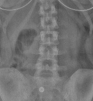 Lumbar project thumbnail