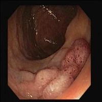 gastric cancer detection using deep learning in colonoscopy video project thumbnail