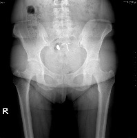 Pelvis AP X-ray project thumbnail