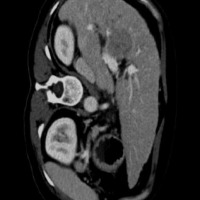 5A_LIVER TUMOR project thumbnail