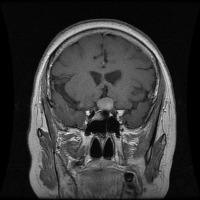 brain-tumor-classification project thumbnail