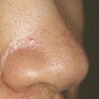 acne-lesion-detection project thumbnail