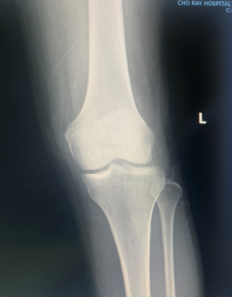 Knee Osteoarthritis Object Detection Dataset and Pre-Trained Model by CS532