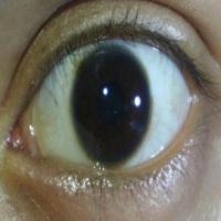eye disease detection  project thumbnail
