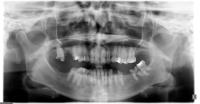 Teeth-Measurement project thumbnail