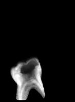pulp_caries project thumbnail