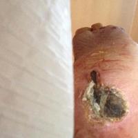wound segmentation project thumbnail