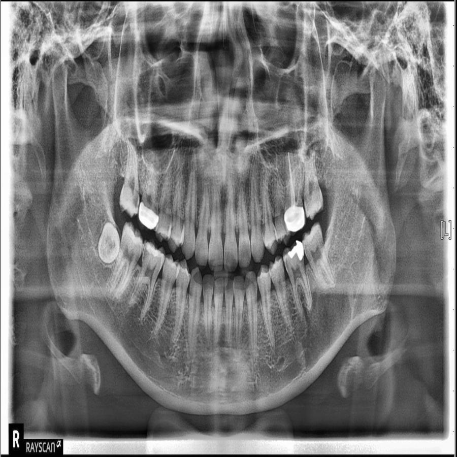 Lesoes_Osteoliticas_segmentacao Instance Segmentation Dataset by Renan