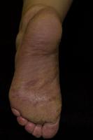psoriasis project thumbnail