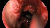 Endoscopic Endonasal Approach project thumbnail