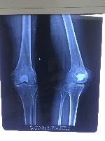Bone_Tumor project thumbnail