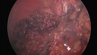 Laparoscopic E L Hepatectomy project thumbnail