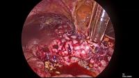 Hepatic cyst fenestration project thumbnail