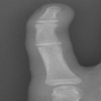 Fracture detection project thumbnail