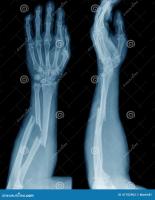 Broken Bone Detection project thumbnail