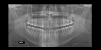 Lamina Dura Loss 3 project thumbnail