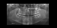 Lamina dura loss 3 semantic project thumbnail