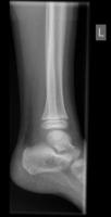 Tumor Bone Segmentation project thumbnail