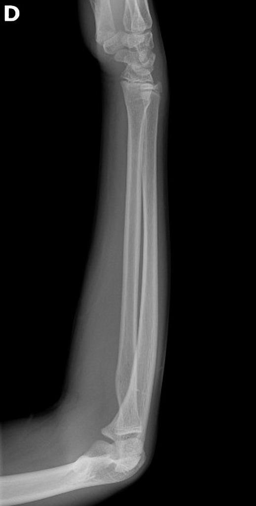 Intelligent bone fracture detection system object detection dataset and