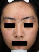 AcneDetection project thumbnail