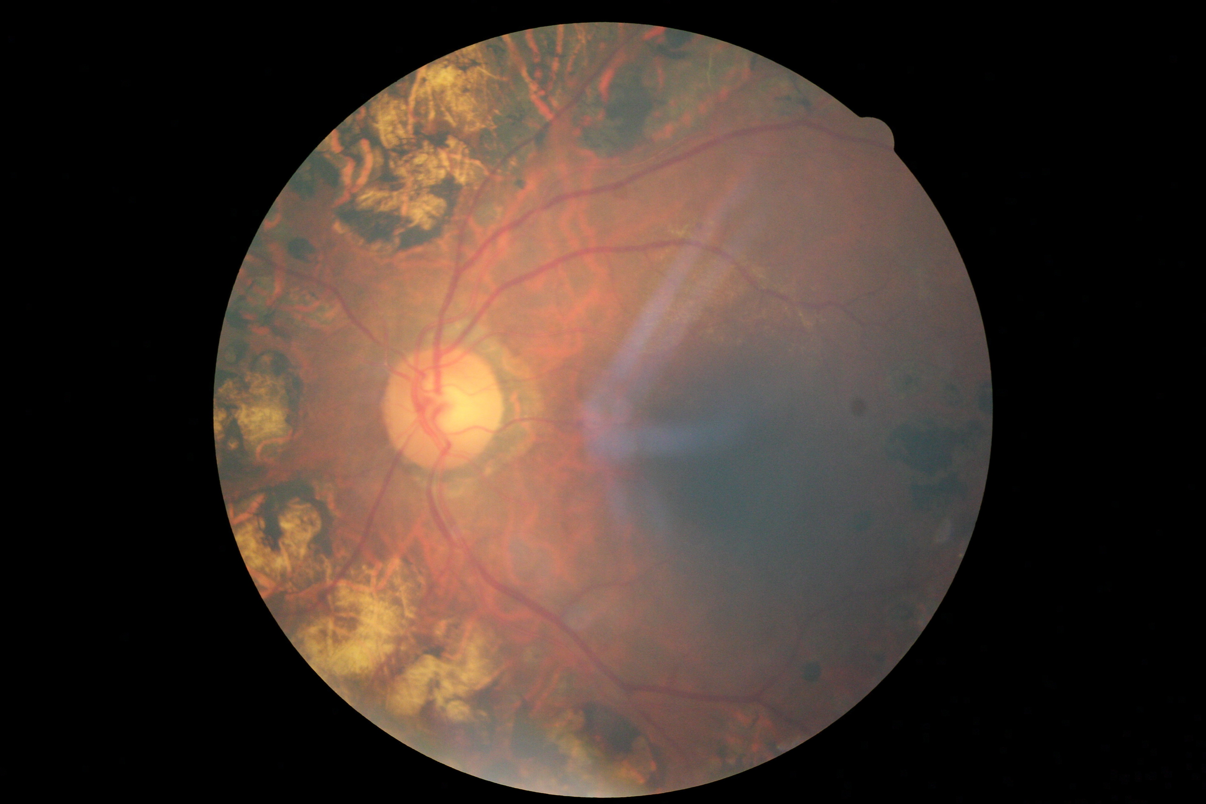 Dr Classification Dataset By Diabetic Retinopathy