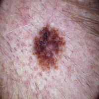 Skin Cancer project thumbnail