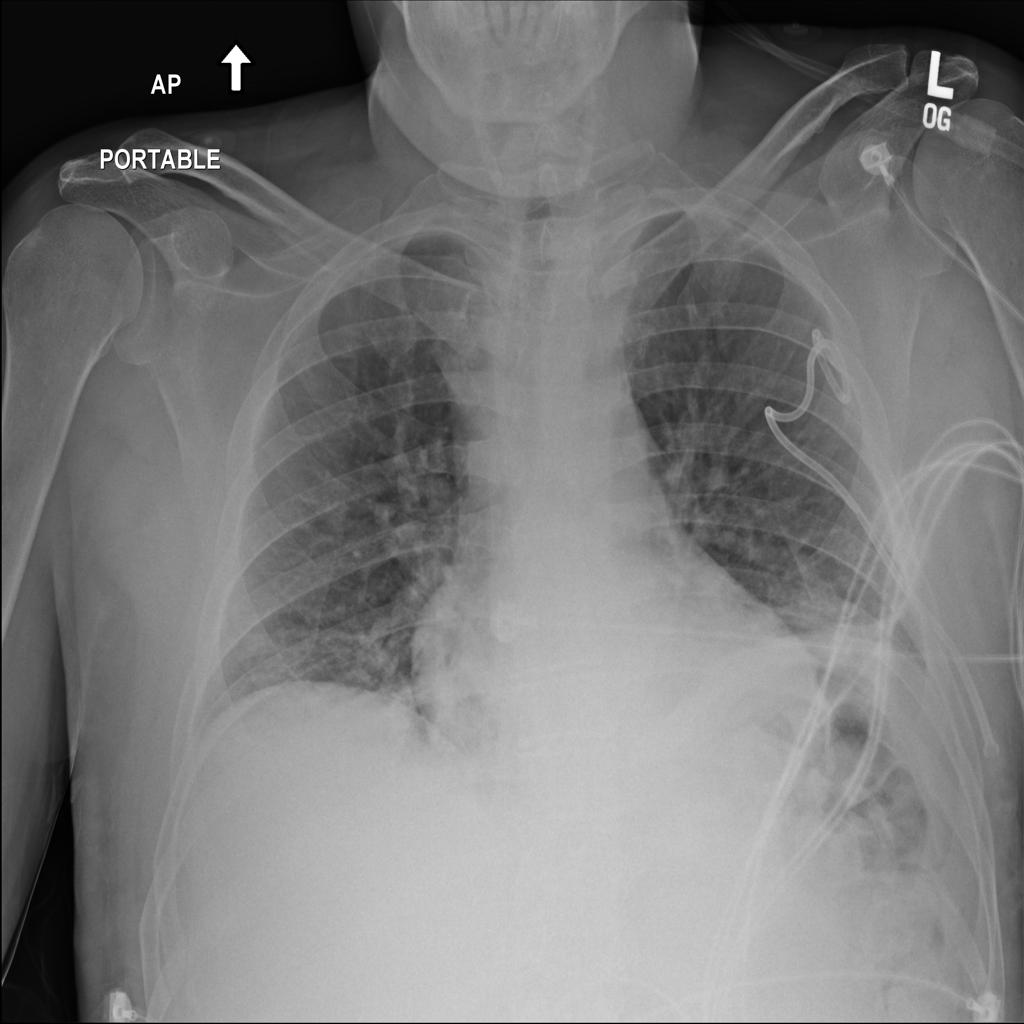 lungdis1-object-detection-dataset-v1-2024-02-17-12-53pm-by-lungcxr