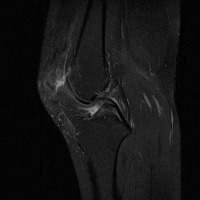 ACL injury severity classifier project thumbnail