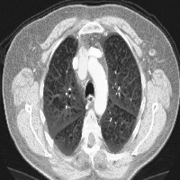 lung cancer. project thumbnail