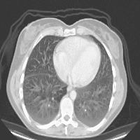 lung cancer.. project thumbnail