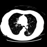lung cancer project thumbnail