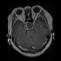 brain-tumor-mri project thumbnail