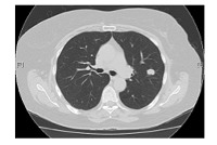 Lung cancer DATASET project thumbnail