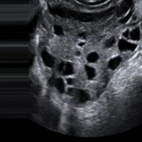 PCOS Diagnosis Object Detection Model by yolo workspace