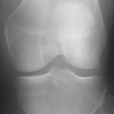 Knee OA detection Object Detection Dataset by SRM