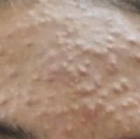Acne project thumbnail