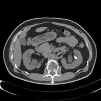 Renal Stone project thumbnail