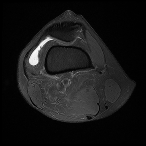 Tibia-Axial Instance Segmentation Dataset by Soumyajit